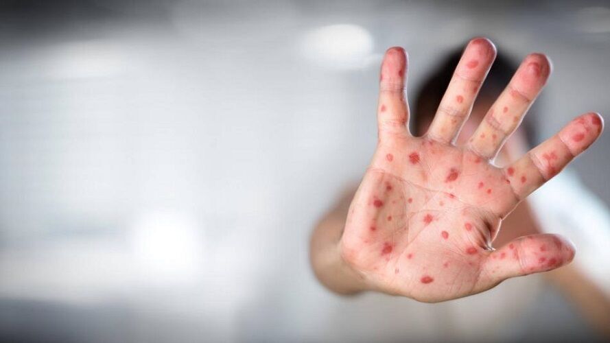 توصیه‌های بهداشتی دانشگاه علوم پزشکی گیلان برای  بیماری آبله میمون