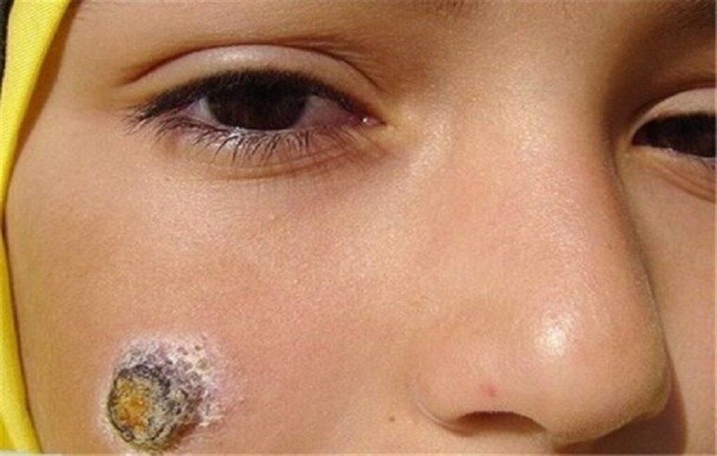 فارس و اصفهان بیشتر موارد شناسایی شده بیماری سالک را دارند